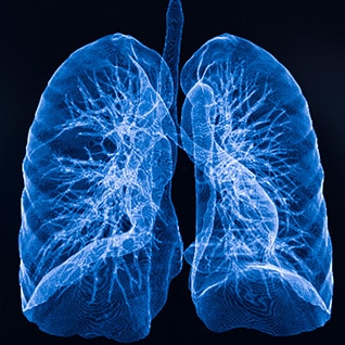 x-ray of lungs